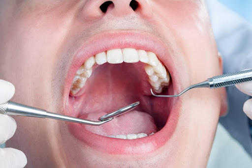 Frequently Asked Questions about Dental Decay?