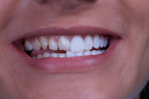 Different Types of Dental Veneers, an Advanced Cosmetic Dental Treatment