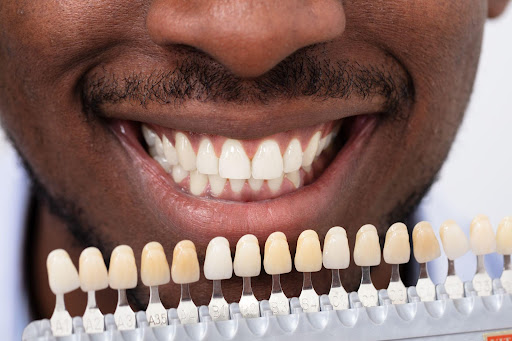 Are Dental Veneers Suitable for Everyone?