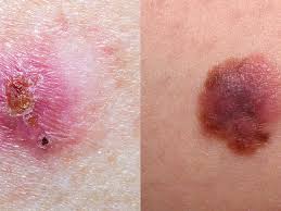 Basal Cell Carcinoma: Causes, Symptoms, And Treatment Basal Cell Carcinoma: Causes, Symptoms, And Treatment